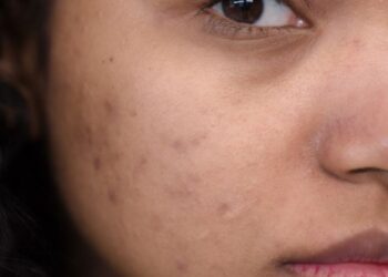 Close-up of a face showing acne scars and blemishes, with a brown skin tone and a focus on the eye and cheek area.