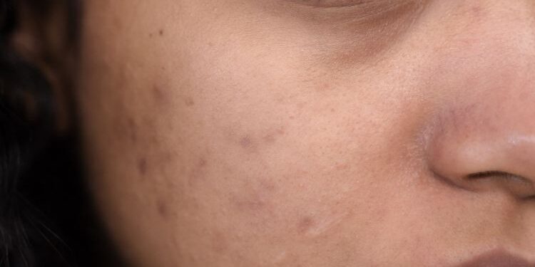 Close-up of a face showing acne scars and blemishes, with a brown skin tone and a focus on the eye and cheek area.